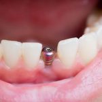 Имплантация зубов: ключ к уверенной улыбке и повышенному качеству жизни